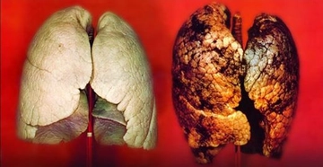 Akciğer Temizleme Kürü Kullanımı ve Faydaları Nelerdir? Akciğer Temizleme Kürü Kullanımı ve Faydaları Nelerdir?